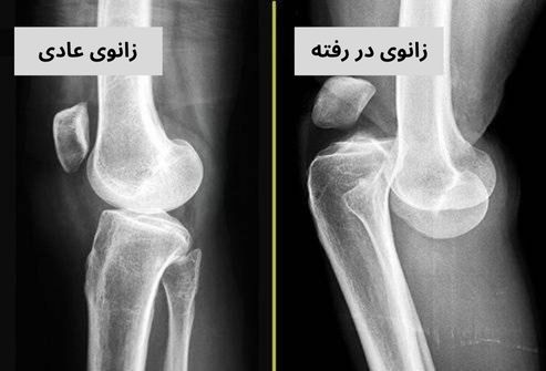 در رفتگی زانو و درمان آن + نشانه های دررفتگی زانو