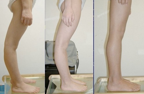 عقب‌رفتگی زانو در کودکان