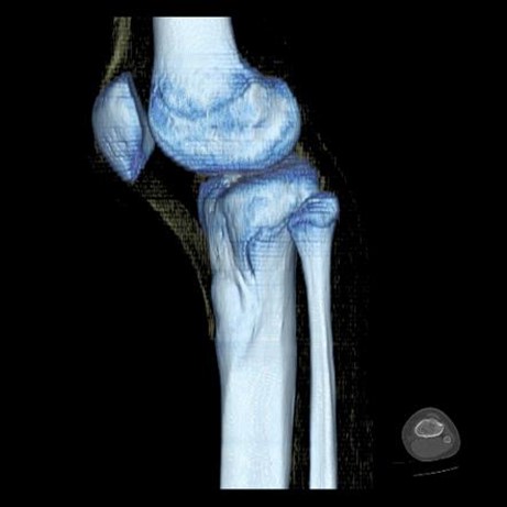 عقب‌رفتگی زانو چیست؟