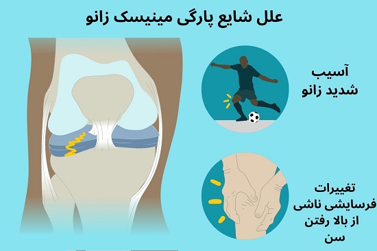 علل پارگی مینیسک زانو